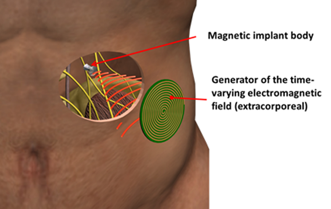 Principle sketch of the "Magnetoceuticals" approach: Only a magnetic implant body  is implanted into the human body. The entire intelligence of the electronic  system is located in the extracorporeal, miniaturized electronics.