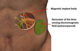 Principle sketch of the "Magnetoceuticals" approach: Only a magnetic implant body  is implanted into the human body. The entire intelligence of the electronic  system is located in the extracorporeal, miniaturized electronics.